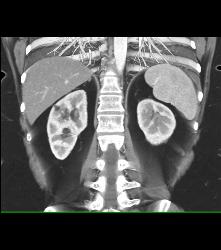 Vascular Renal Cell Carcinoma Grows Into Renal Vein and Inferior Vena Cava (IVC) - CTisus CT Scan