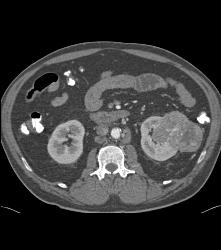 Vascular Renal Cell Carcinoma Grows Into Renal Vein and Inferior Vena Cava (IVC) - CTisus CT Scan