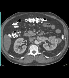 Vascular Renal Cell Carcinoma Grows Into Renal Vein and Inferior Vena Cava (IVC) - CTisus CT Scan