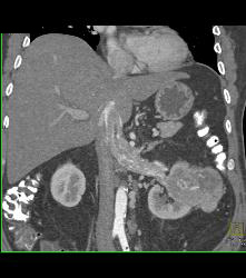 Vascular Renal Cell Carcinoma Grows Into Renal Vein and Inferior Vena Cava (IVC) - CTisus CT Scan