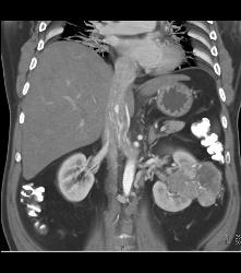 Vascular Renal Cell Carcinoma Grows Into Renal Vein and Inferior Vena Cava (IVC) - CTisus CT Scan