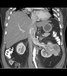 Vascular Renal Cell Carcinoma Grows Into Renal Vein and Inferior Vena Cava (IVC) - CTisus CT Scan