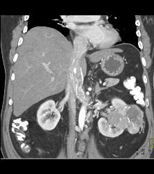 Vascular Renal Cell Carcinoma Grows Into Renal Vein and Inferior Vena Cava (IVC) - CTisus CT Scan