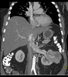 Vascular Renal Cell Carcinoma Grows Into Renal Vein and Inferior Vena Cava (IVC) - CTisus CT Scan