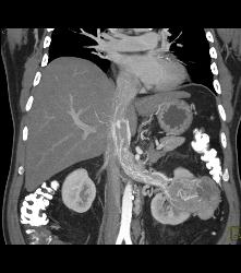 Vascular Renal Cell Carcinoma Grows Into Renal Vein and Inferior Vena Cava (IVC) - CTisus CT Scan