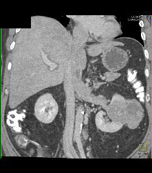 Vascular Renal Cell Carcinoma Grows Into Renal Vein and Inferior Vena Cava (IVC) - CTisus CT Scan