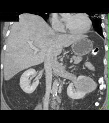 Vascular Renal Cell Carcinoma Grows Into Renal Vein and Inferior Vena Cava (IVC) - CTisus CT Scan