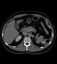 Partial Nephrectomy Changes - CTisus CT Scan