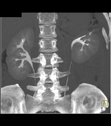 Partial Nephrectomy Changes - CTisus CT Scan