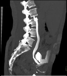 Dilated Ureter and Neobladder - CTisus CT Scan