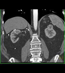 2 Cm Left Renal Cell Carcinoma - CTisus CT Scan