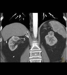 2 Cm Left Renal Cell Carcinoma - CTisus CT Scan