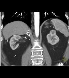 2 Cm Left Renal Cell Carcinoma - CTisus CT Scan