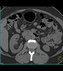 Right Renal 2cm Angiomyolipoma (AML) - CTisus CT Scan