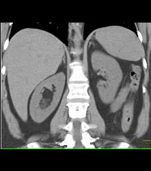 Right Renal 2cm Angiomyolipoma (AML) - CTisus CT Scan