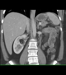 Right Renal 2cm Angiomyolipoma (AML) - CTisus CT Scan