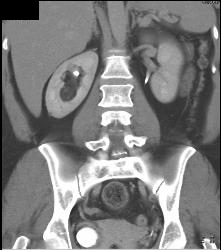 Right Renal 2cm Angiomyolipoma (AML) - CTisus CT Scan