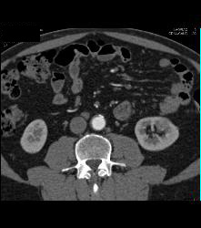 Subtle 2cm Left Rneal Cell Carcinoma- Best Seen on Excretory Phase - CTisus CT Scan