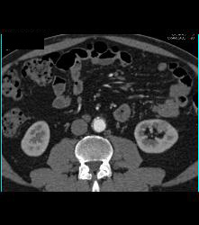 Subtle 2cm Left Rneal Cell Carcinoma- Best Seen on Excretory Phase - CTisus CT Scan