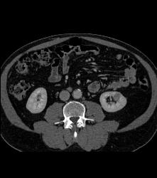 Subtle 2cm Left Rneal Cell Carcinoma- Best Seen on Excretory Phase - CTisus CT Scan