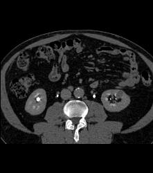 Subtle 2cm Left Rneal Cell Carcinoma- Best Seen on Excretory Phase - CTisus CT Scan