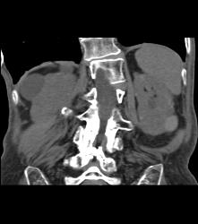 High Density Renal Cyst - CTisus CT Scan