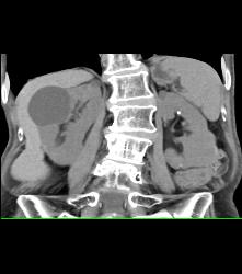 Cystic Renal Cell Carcinoma on Left - CTisus CT Scan