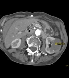 Cystic Renal Cell Carcinoma on Left - CTisus CT Scan