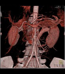 Retroaortic Renal Vein - CTisus CT Scan