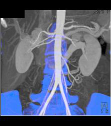 Retroaortic Renal Vein - CTisus CT Scan