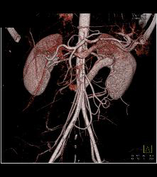 Retroaortic Renal Vein - CTisus CT Scan