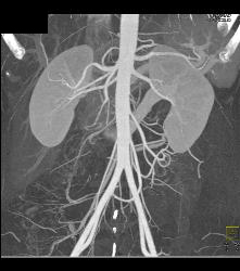 Retroaortic Renal Vein - CTisus CT Scan