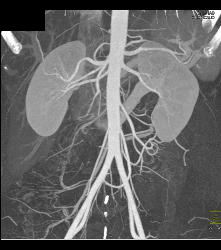 Retroaortic Renal Vein - CTisus CT Scan