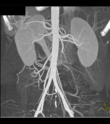 Retroaortic Renal Vein - CTisus CT Scan