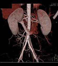 Retroaortic Renal Vein - CTisus CT Scan