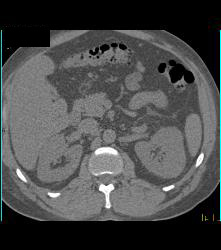 Acute Pyelonephritis- Multiple Phases - CTisus CT Scan