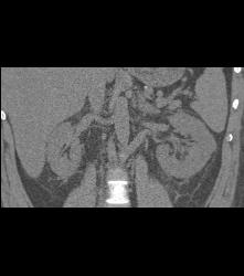 Acute Pyelonephritis- Multiple Phases - CTisus CT Scan