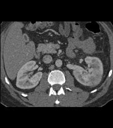 Acute Pyelonephritis- Multiple Phases - CTisus CT Scan