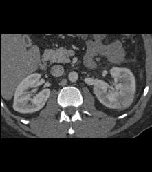 Acute Pyelonephritis- Multiple Phases - CTisus CT Scan