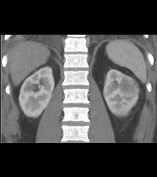 Acute Pyelonephritis- Multiple Phases - CTisus CT Scan