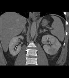 Acute Pyelonephritis- Multiple Phases - CTisus CT Scan