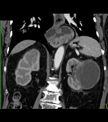 High Density Renal Cyst- Right Kidney- and Cystic Renal Cell Carcinoma in Left Kidney - CTisus CT Scan