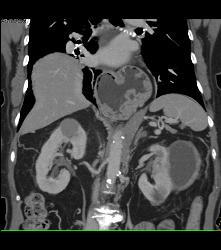 High Density Renal Cyst- Right Kidney- and Cystic Renal Cell Carcinoma in Left Kidney - CTisus CT Scan