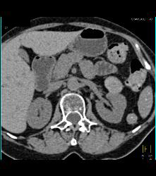 High Density Left Renal Cyst - CTisus CT Scan