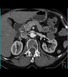 High Density Left Renal Cyst - CTisus CT Scan