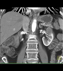 High Density Left Renal Cyst - CTisus CT Scan