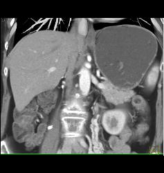 Right Nephrectomy - CTisus CT Scan