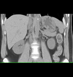 1 Cm Renal Artery Aneurysm - CTisus CT Scan