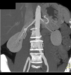 1 Cm Renal Artery Aneurysm - CTisus CT Scan