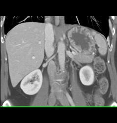 1 Cm Renal Artery Aneurysm - CTisus CT Scan